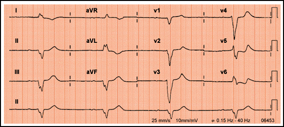ECG 2