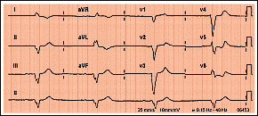 Pulse para ampliar el ECG