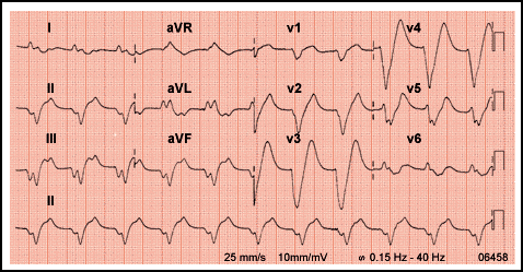 ECG 3