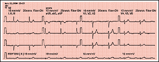 Pulse para ampliar el ECG