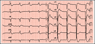 Pulse para ampliar el ECG